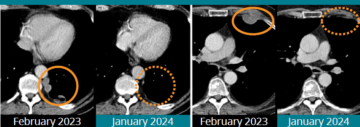 New frontiers in exploiting stroma for therapy. FAP directed precision medicine. Phase I of AVA600 showing tolerability, plasmas/tumour PK and clinical proof of concept response in FAP high tumours. Abstract CT188 #AACR2024 @ICR_London @royalmarsdenNHS @ECMC_UK