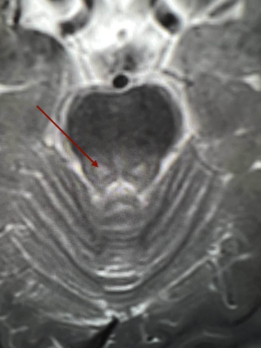 Tip of the day 💡: Central Tegmental Tracts these are, and they are abnormally bright in this 4 year old. Mostly non-specific as a finding, but can be seen in an ever increasing list of conditions. This child only had headaches. Would you screen more or draw the line?