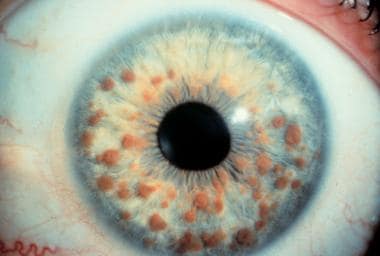 𝘾𝙇𝙄𝙉𝙄𝘾𝘼𝙇_𝙌𝙐𝙄𝙕

🍁#Lisch Nodules are tiny harmless regular brown hematomas on the iris, in which disease they are seen❓

A) Sarcoidosis 
B) Horner's Syndrome 
C) Multiple Myeloma 
D) Neurofibromatosis type 1

#medx 
#MedTwitter