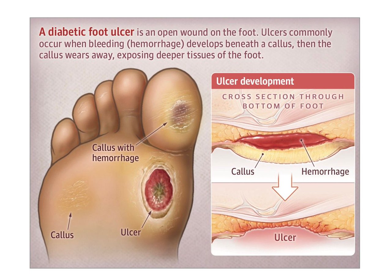JAMA: Diabetic Foot Infections and Amputations Are All Too Common-Here’s What Could Move the Needle #ActAgainstAmputation @USC_Vascular @CaitlinWHicks @ALPSlimb @APMA @USC @Cortes_Penfield @KeckSchool_USC diabeticfootonline.com/2024/03/08/jam…
