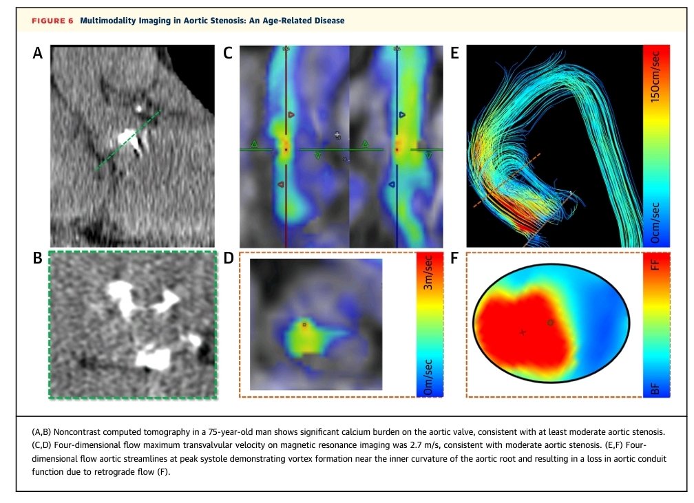 Noninvasive Techniques for Tracking Biological Aging of the Cardiovascular System. Published in JACC IMAGING ➡️ doi.org/10.1016/j.jcmg… 🙏 to @zahra_raisi & @s_e_petersen for involving me in CMRs role in tracking Ageing. @JACCJournals @EACVIPresident @ACCinTouch @BSCMR @BSEcho