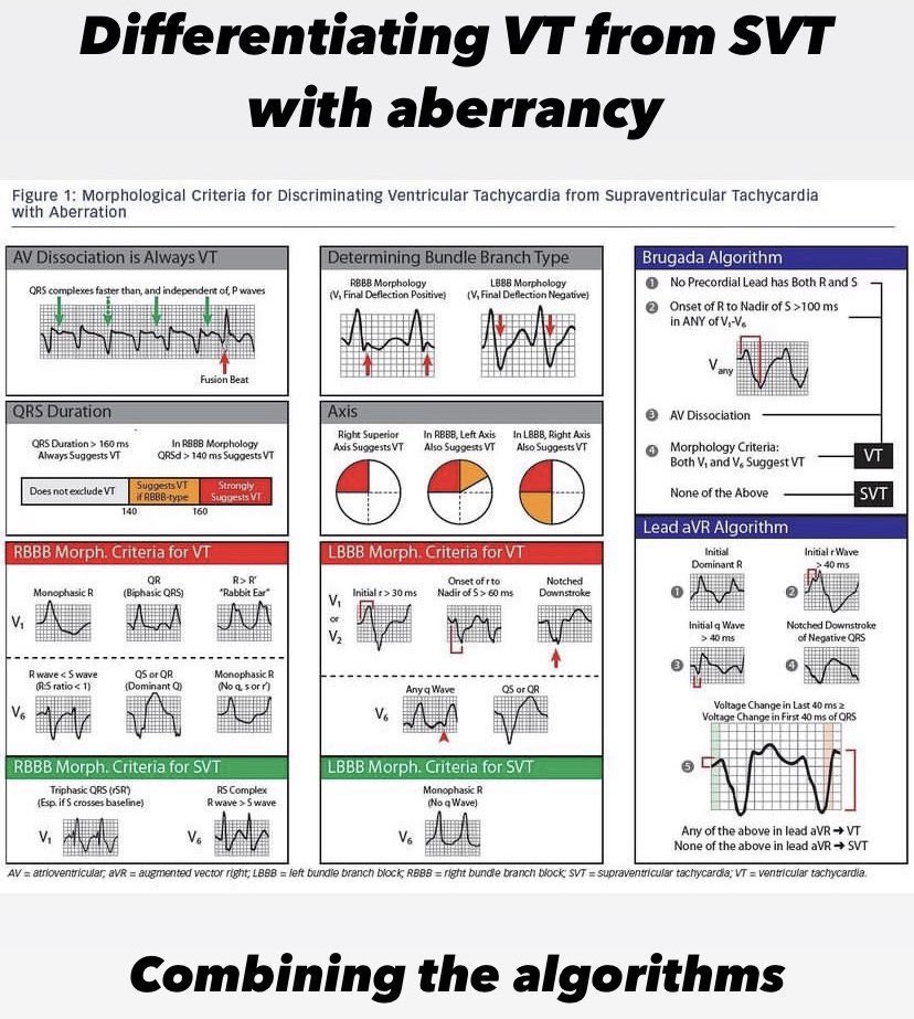 VT vs SVT with aberrancy 🤜🤛, a #FIT review. Spaced repetition – the key to learning 🧠👇 #MedEd