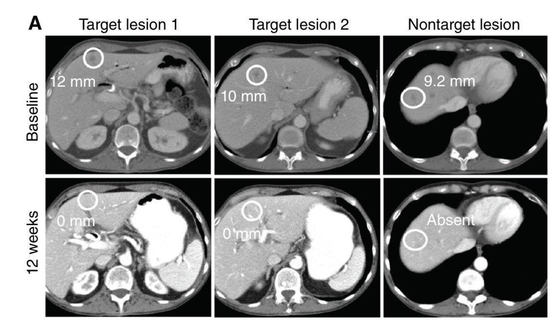 The Revolution Medicines #AACR24 #RASBonanza continues - now in @CD_AACR of their CLINICAL grade RAS(ON) multiRAS inhibitor - including peer reviewed publication of the 1st clinical responses in #PancreaticCancer & other KRAS mutant tumors. aacrjournals.org/cancerdiscover…