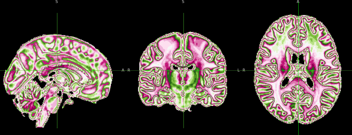 writing code to import <a href="/ColorBrewer/">Cindy Brewer</a> palettes into <a href="/FSLeyes/">FSLeyes</a> for neuroimaging analysis. work in progress but it sure is pretty 🧠🗺️🎨