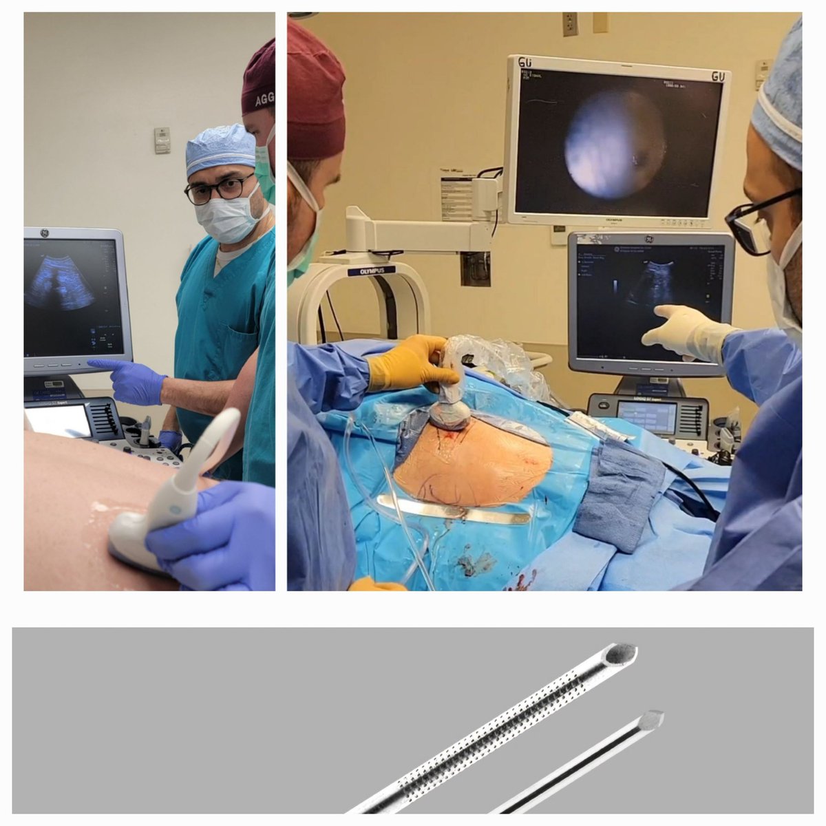 Nazih Paul Khater, MD, FACS (@nazihkhatermd) on Twitter photo 🚨Ultrasound-Guided Renal Access for #PCNL in the OR,4 steps✅
1️⃣Map out kidney/ribs
2️⃣US probe:Longit/Transv. tilt🎯
3️⃣Adjust Chiba needle"plastic indicator"prn(pre-op CT✅SSD)
4️⃣"Echo-tip"💉seen🖥️
<a href="/AmerUrological/">Amer. Urol. Assn.</a> <a href="/SES_AUA/">Southeastern Section</a> <a href="/Endo_Society/">Endourological Society</a> <a href="/so_uro/">UroSoMe</a> #education #resident #endourology 🚨Ultrasound-Guided Renal Access for #PCNL in the OR,4 steps✅
1️⃣Map out kidney/ribs
2️⃣US probe:Longit/Transv. tilt🎯
3️⃣Adjust Chiba needle"plastic indicator"prn(pre-op CT✅SSD)
4️⃣"Echo-tip"💉seen🖥️
<a href="/AmerUrological/">Amer. Urol. Assn.</a> <a href="/SES_AUA/">Southeastern Section</a> <a href="/Endo_Society/">Endourological Society</a> <a href="/so_uro/">UroSoMe</a> #education #resident #endourology