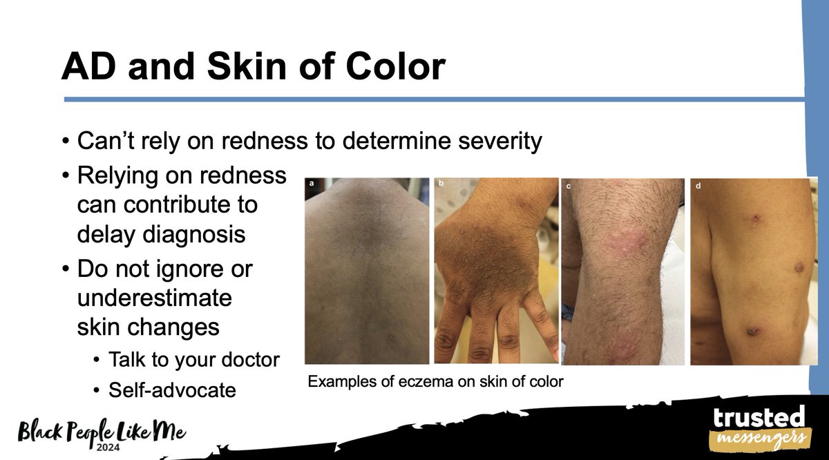 #Eczema in skin of color. Rules to remember ! DO not rely on redness to determine severity and do not ignore or underestimate skin changes. Talk to your doctor and advocate or you and your skin!us02web.zoom.us/webinar/regist…