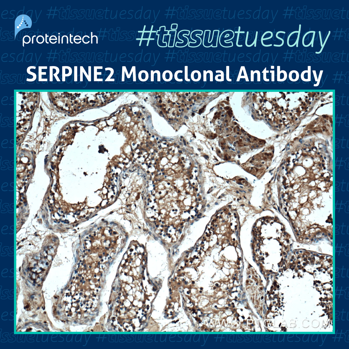 SERPINE2 is a protease inhibitor that is upregulated testicular cancer and plays a role in tumor progression and metastasis. Try Proteintech’s SERPINE2 Monoclonal antibody to further accelerate your testicular cancer research. More info: ow.ly/MbqJ50RaN2N