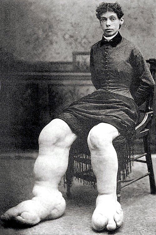 Fanny Mills was born in 1860 and suffered from Milroy’s Disease. 

Milroy's disease is an inherited condition marked by lymphedema, typically affecting the legs, resulting from congenital defects in the lymphatic system. 

Impaired lymph drainage causes fluid buildup and…