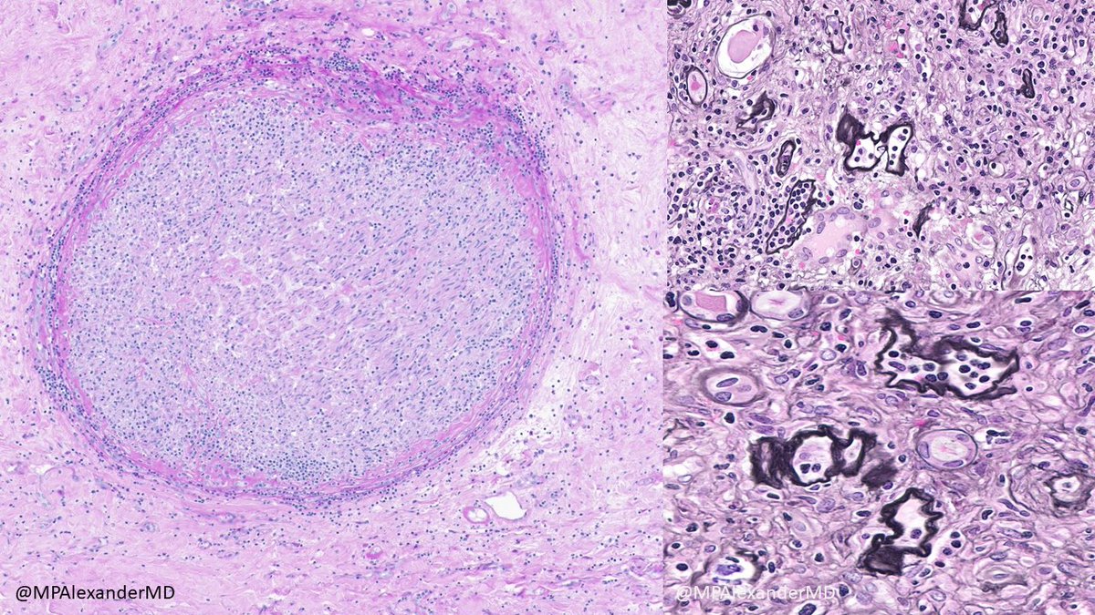 Allograft with both T cell & antibody mediated rejection. Transplant arteriopathy with endothelialitis. Neural infiltration by immune cells. Peritubular capillaritis & peritubular capillaropathy (thick basement membranes: silver stain). Advanced IFTA & glomerular sclerosis.