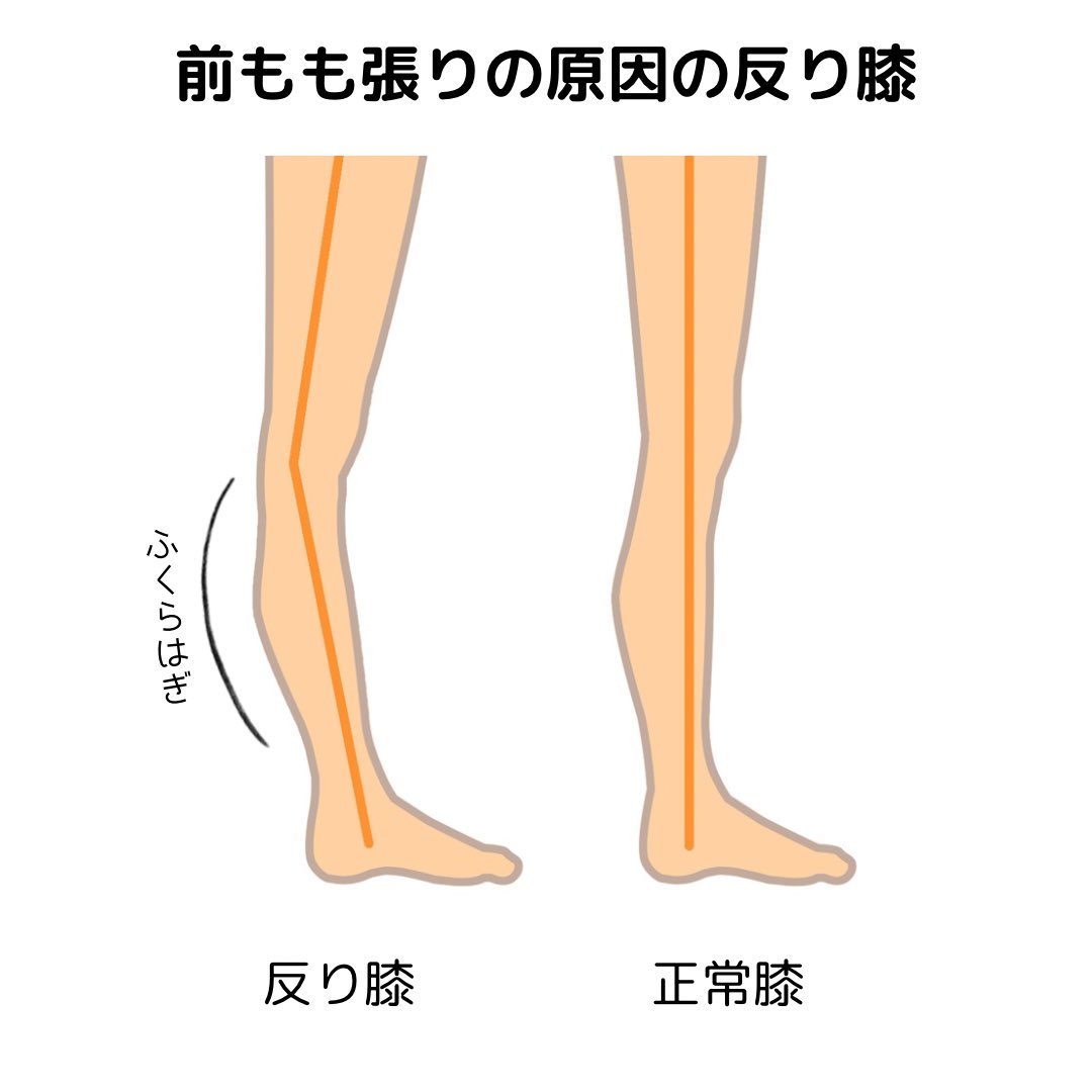 ももがパンパンやガチガチで悩んでる人は スネが後ろに反ってないか確認して欲しい というのもスネが後ろに反る反り膝だと 必要以上に膝に負担がかかり 前ももがパンパンになる じゃ反り膝って何でなるの？というと 元になっているのが 実はふくらはぎの張り このふくらはぎ張りを改善するには…