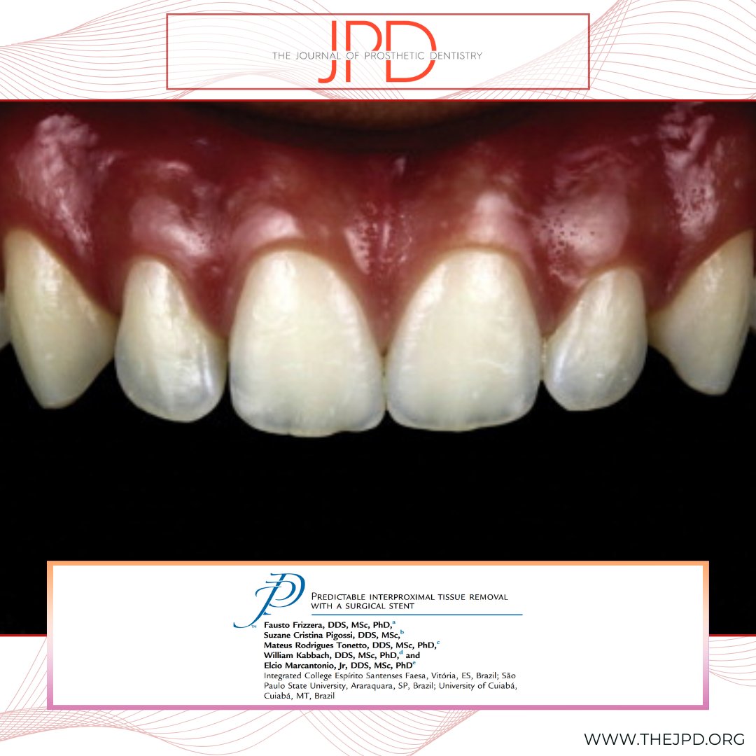 JPDentistry's tweet photo. Learn more about this #dentaltechnique that shows a straightforward way to make a #surgicalguide to predictably crown lengthen at the interproximal region within 5mm of the planned #tooth contacts to avoid developing black triangles: https://t.co/mucWPEiWZ8 https://t.co/OfcVOQJ2fa