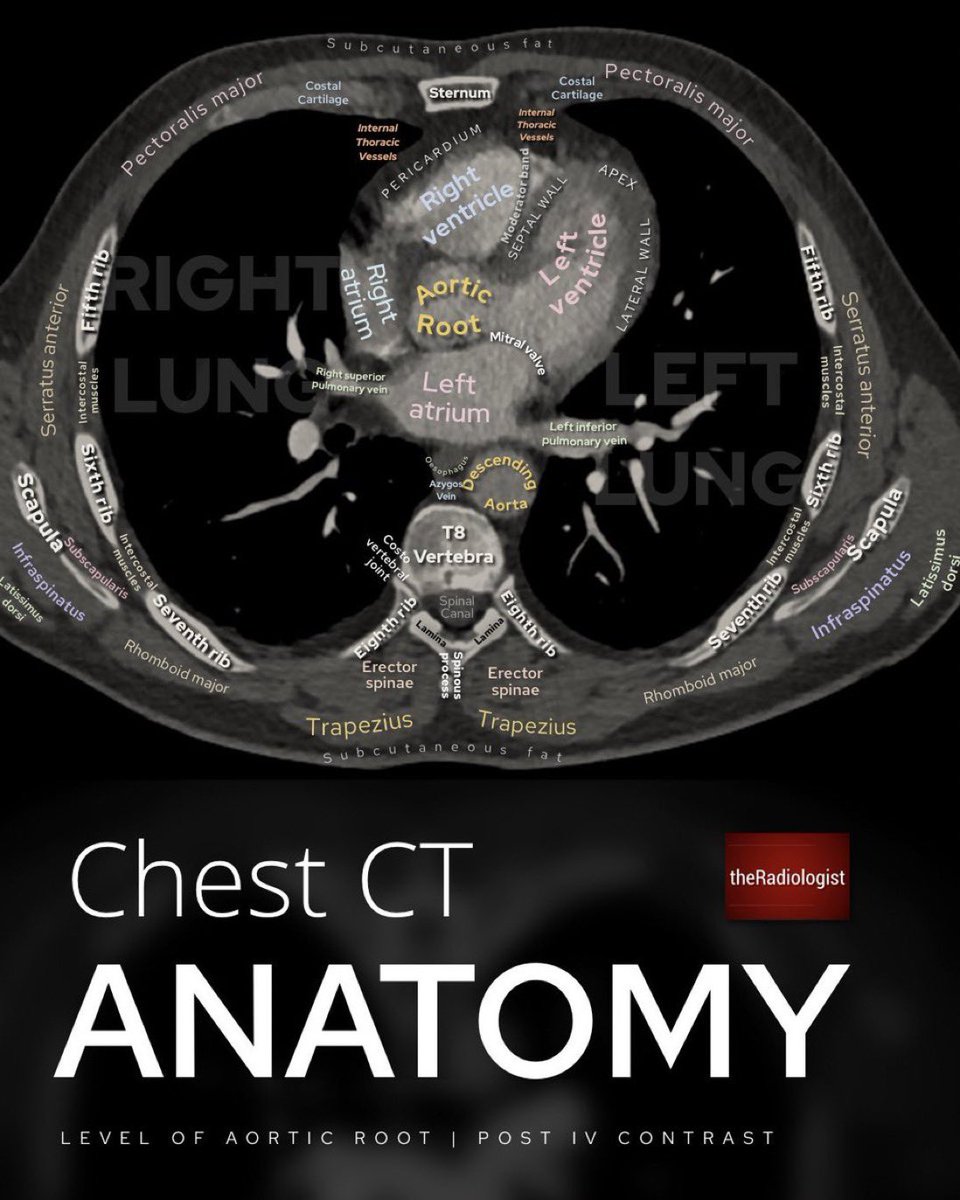 Very helpful Chest CT anatomy at level of aortic root 🫀 From @radiologistpage #chestrad @ChestradRoy @n_nidhidesai95 @alulamd