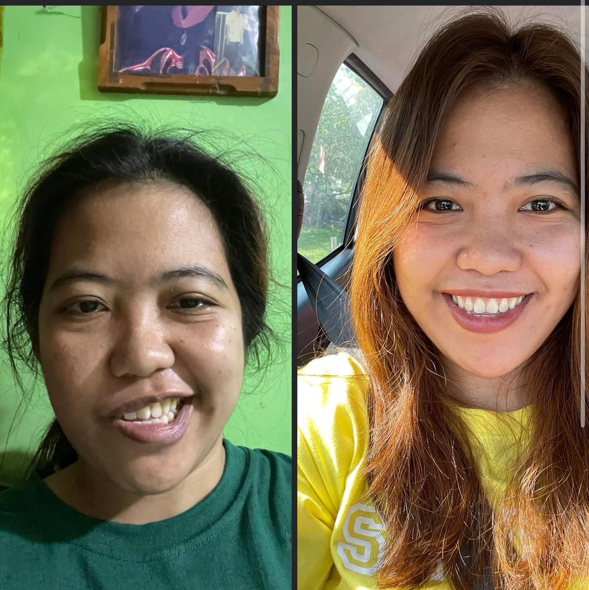 drop selca or bad april 🐥🩷
Left side was taken 3 months ago, facial paralysis after operations due to ear infection. 
Thank God for healing and His provision. 
#exol #labanlangsabuhay #roadtorecovery
