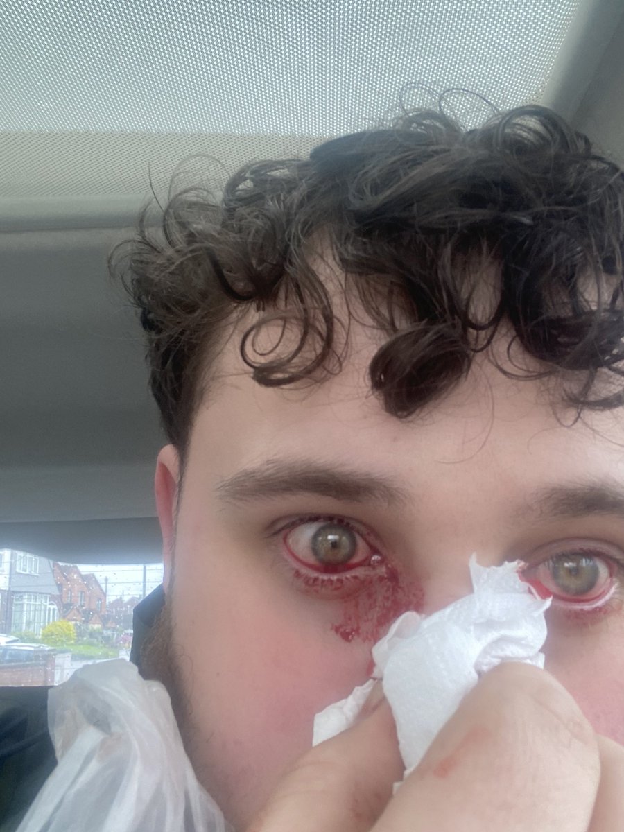 ItsMePrimal's tweet photo. Had A nosebleed it was like this for 1.5 hours maybe abit longer and by the time I got to an a&amp;e and seen it had stopped and they wouldn’t send me to a ENT but surely this is something that needs to be sorted right away or atleast find out why it’s so bad this happens often a lot https://t.co/uroCb5KH2u