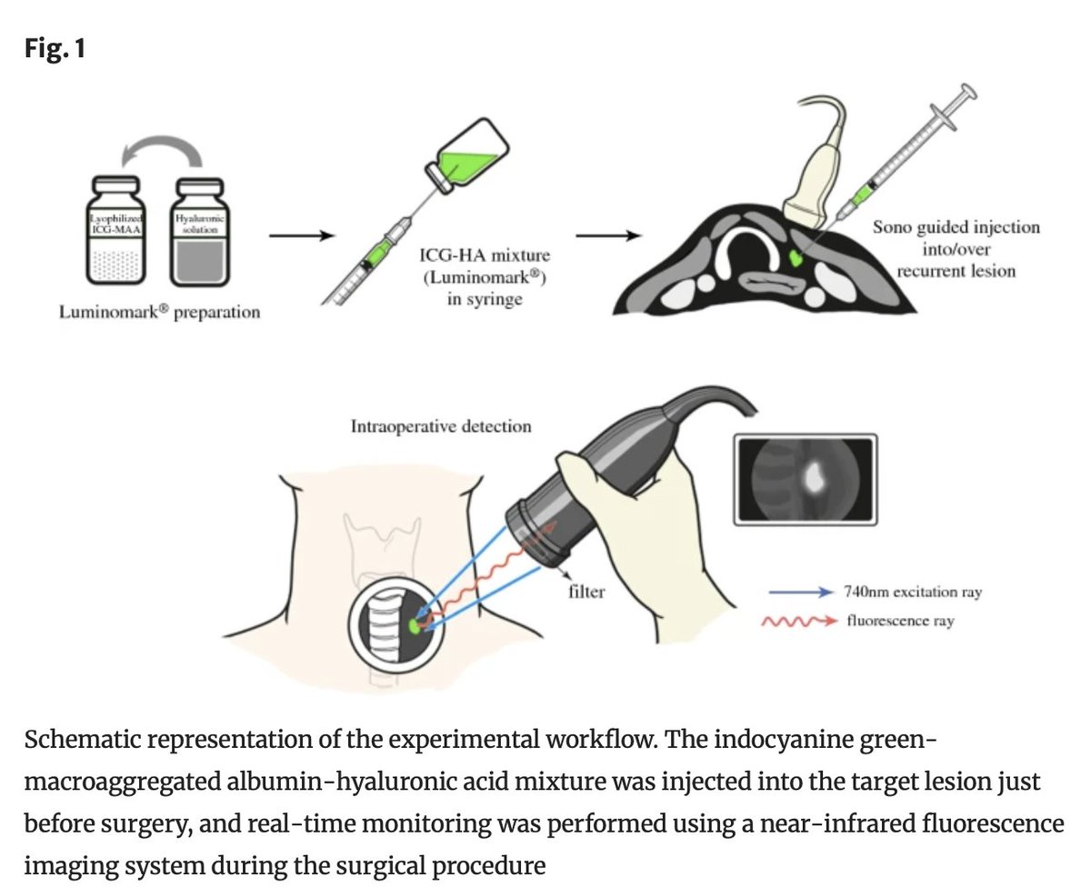 APRIL ISSUE: The Efficacy and Safety of an #IndocyanineGreen-Macroaggregated Albumin-Hyaluronic Acid Mixture (LuminoMark™) for Surgical Localization of Recurrent #ThyroidCancer. rdcu.be/dEho6 @SocSurgOnc