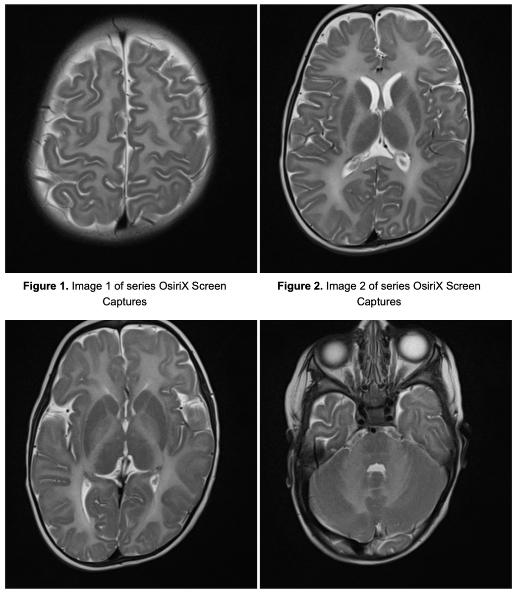 10M/M. Developmental Delay. Describe pathologies, type of disease and possible disease. #Neurorad #radiology #epilepsy #radres #MedEd #Medicine #Neurology #peds #radres #futureradres @The_ASPNR @drbejoy2002