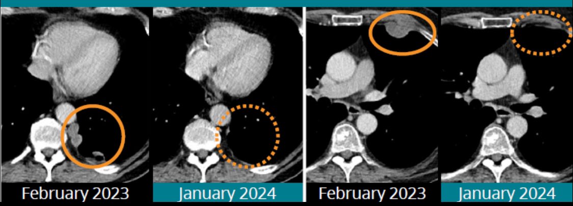 Easy to forget #AVCT was never meant to continue dose escalating, they were never meant to see deep, meaningful efficacious responses in a heavily pre-treated patient population. This ‘safety’ trial talks to efficacy because this heavily pre-treated, very sick, patient