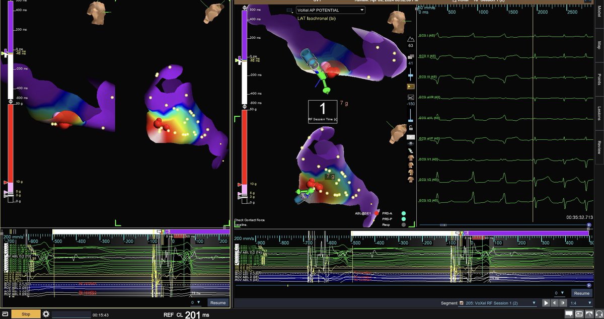 Left posteroseptal AP with negative delta wave in II. Earliest ventricular activation in CS branch was on top of LCx. Going transeptal beautiful AP potential on annulus and got it in less than 1 second! Arruda criteria not very specific CS location. @forkknifecab_EP #EPeeps