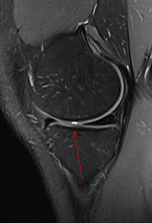 themskarchive's tweet photo. 10/4/2024. For traumatologists and rehabilitation specialists, what are your recommendations for managing these deep chondral lesions around the #knee (4 mm) in young, active adults? #msk #traumatwitter #orthotwitter #radtwitter https://t.co/SHh782dFFu