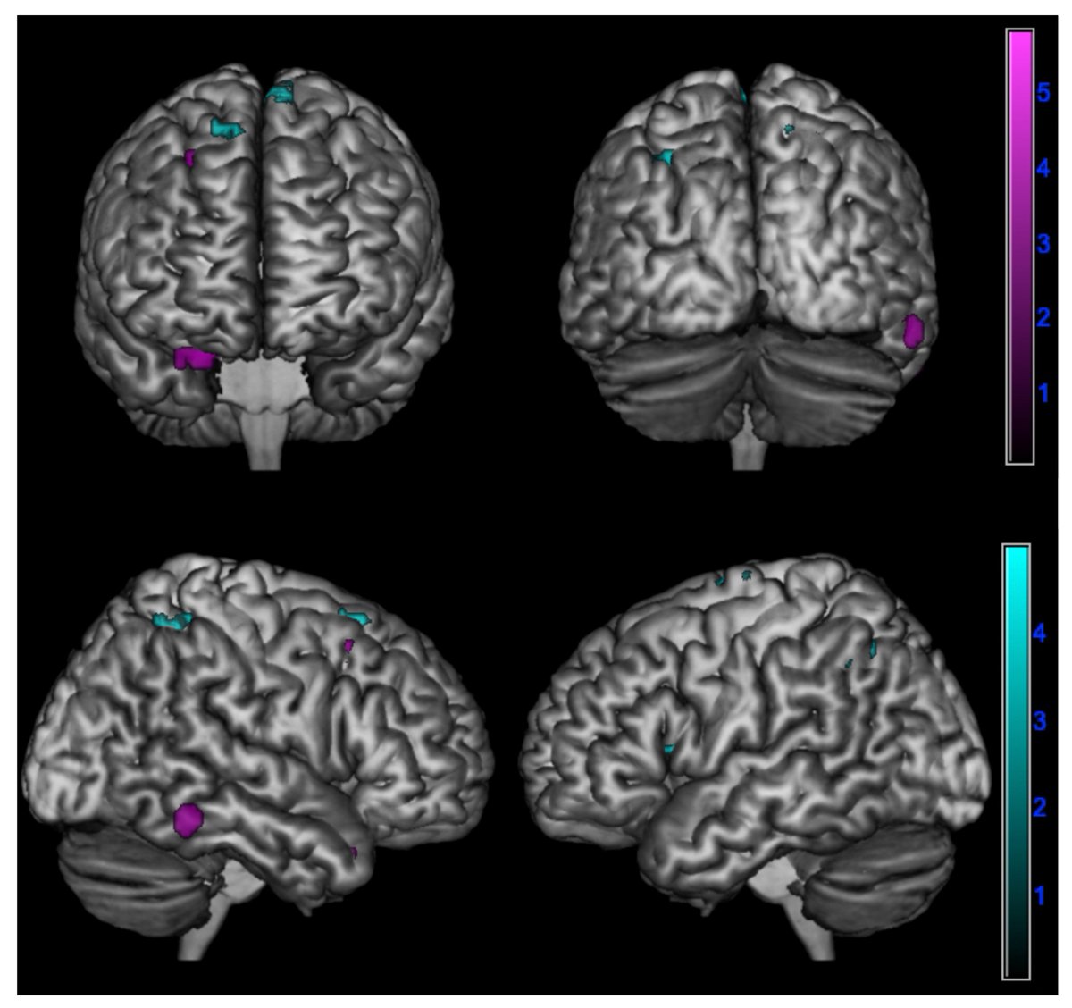 🍄Enjoy today's #Notable Paper 'Differences and Similarities in Empathy Deficit and Its Neural Basis between Logopenic and Amnesic #Alzheimer’s Disease' 👨‍🔬Giulia Giacomucci et al. @UNI_FIRENZE 🍀Altmetric: 10 🔗mdpi.com/2092756 @MDPIOpenAccess @MediPharma_MDPI