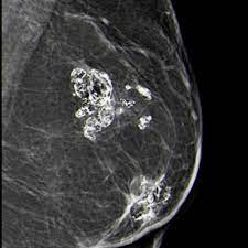 Fat necrosis occur most commonly in the breasts due to different pathologies and causes . What repalace fat tissue on the long term as seen? #MedTwitter #MedEd #MedX #Medicine A. #Collagen. B. #Fibrillin. C. #Amyloid. D. #Calcium.