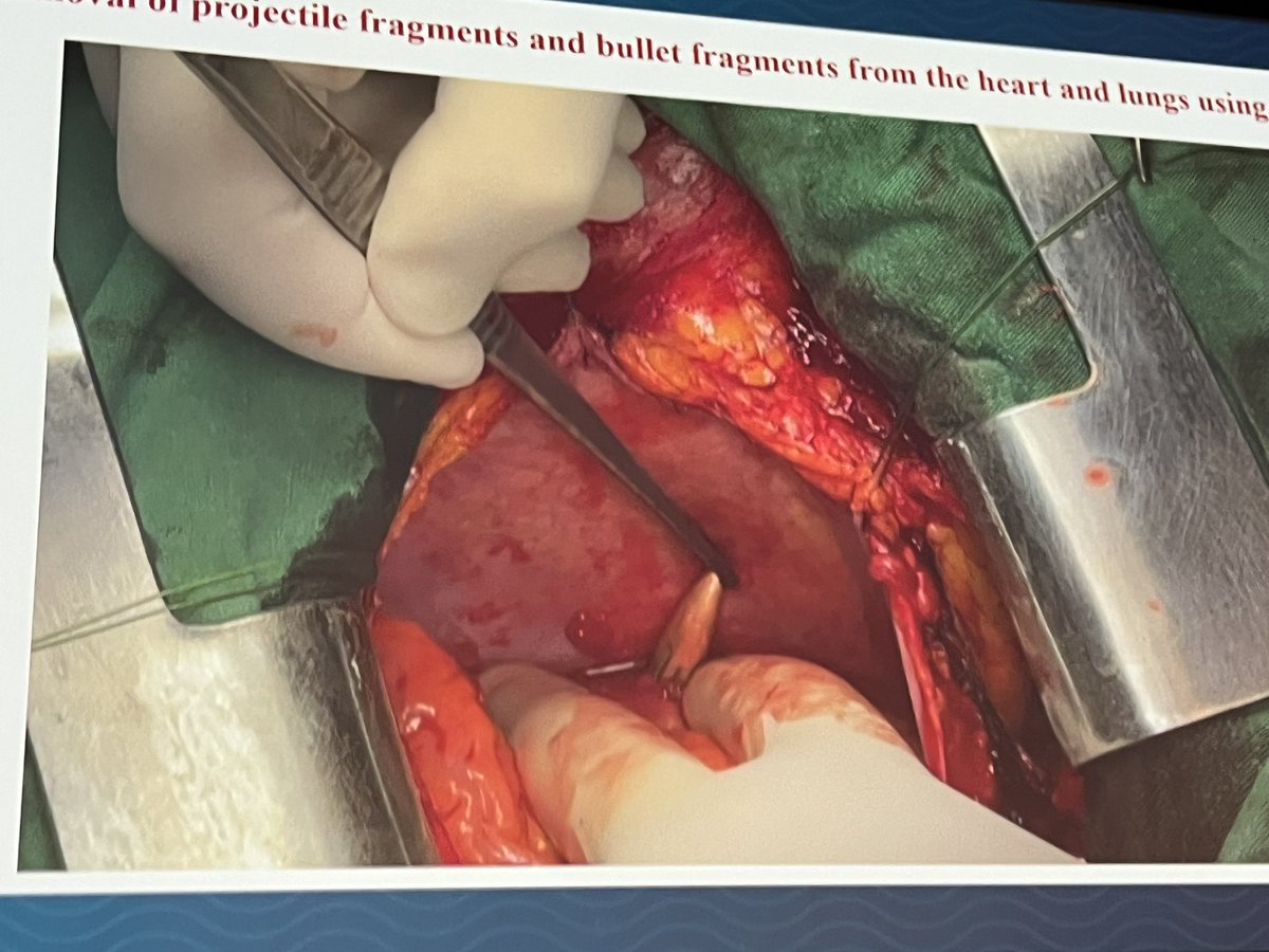 BrozziNico79954's tweet image. Strong kick-off #ISHLT2024 with an inspiring presentation by @btodurov on #HeartSx #HeartTx in #Ukraine. @ISHLT