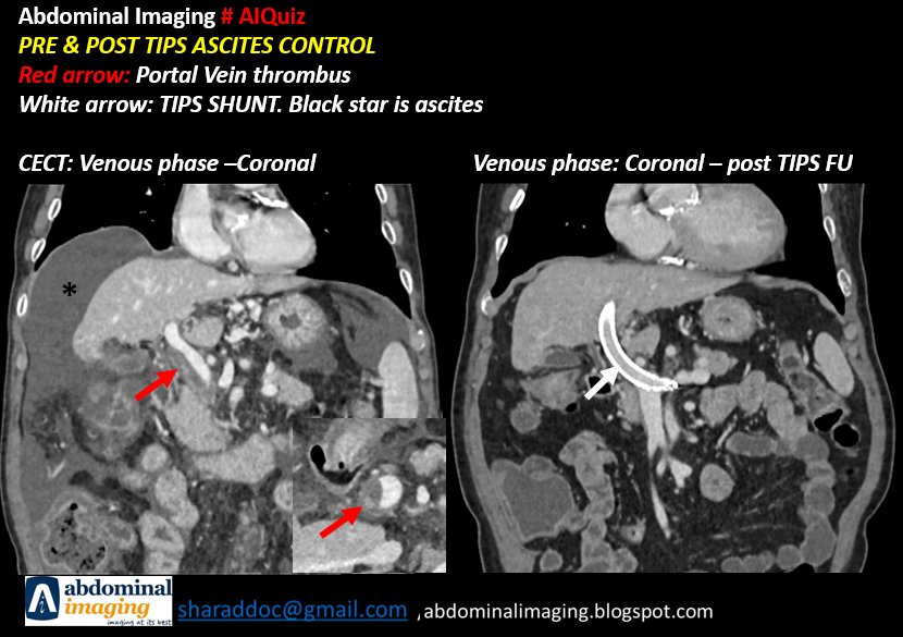 Abdominal imaging #AIQuiz 

Control of recurrent variceal bleed by TIPS in a case of 'Decompensated Cirrhosis with Partial Portal Vein Thrombosis. Note significantly reduced collaterals in left gastric territory.

#radtwitter #foamed #foamrad #radiology #cirrhosis #pvthrombosis