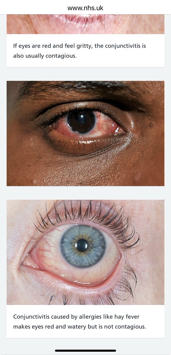 Good to see the @NHSEngland are starting to use images that show what conditions look like on people with different skin tones. On a separate note I always thought you had to get eye drops from the pharmacy for conjunctivitis, but apparently not.