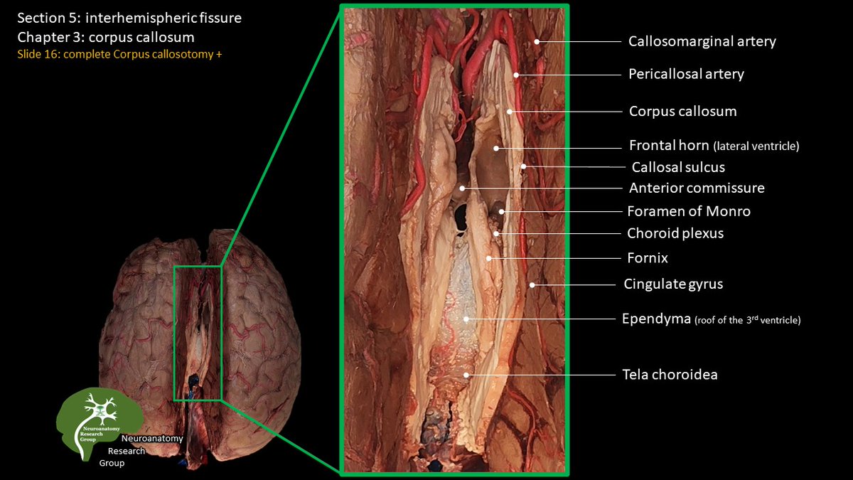 Anatomical dissection and complete 𝗖𝗼𝗿𝗽𝘂𝘀 𝗖𝗮𝗹𝗹𝘀𝗼𝘁𝗼𝗺𝘆 showing: 

-Callosomarginal artery
-Pericallosal artery
-Corpus callosum
-Frontal horn
-Callosal sulcus
-Anterior commissure
-Foramen of Monro
-Choroid plexus
-Fornix
-Cingulate gyrus
-Ependyma
-Tela choroidea