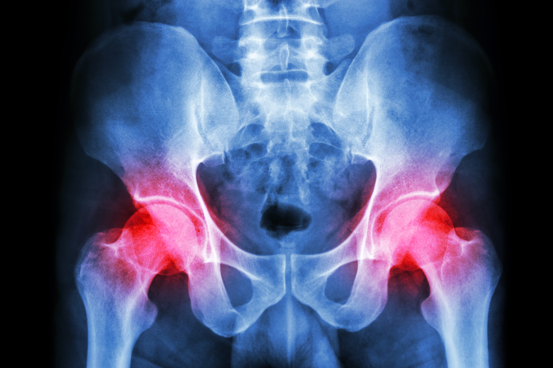 MillerReview's tweet image. In the latest #OrthoBuzz, #JBJS Deputy Editor for Social Media Dr. Matt Schmitz discusses a new study on the impact of robotic assistance and computer navigation on periprosthetic joint infection after primary total hip arthroplasty.
Read it here: tinyurl.com/2tjt92rj