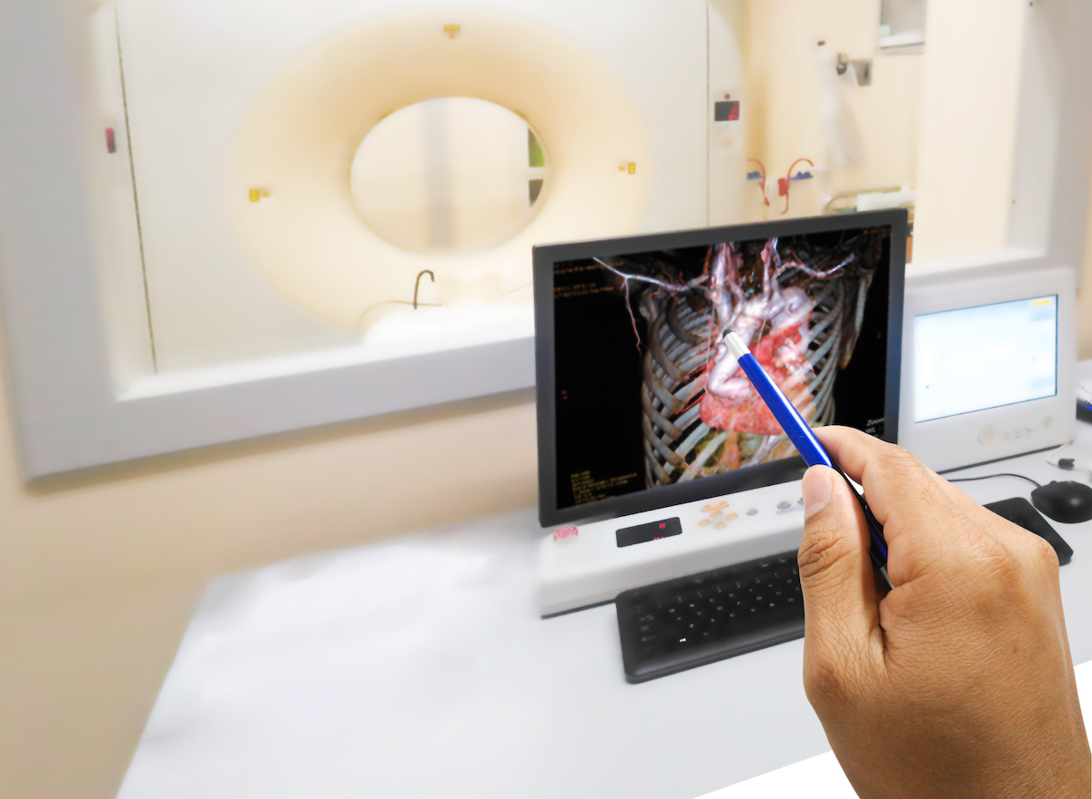 Researchers with @YaleIMed say their new #AI tool can help predict #aortic stenosis. Writing in @JamaCardio, @rohan_khera and colleagues say the Digital AS Severity Index predicts which #patients will #progress to a severe form of aortic stenosis. brnw.ch/21wIGUw