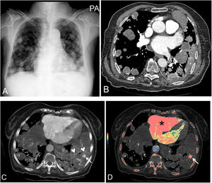 📷 Hoy exploramos una imagen clínica: ' Pseudoaneurismas de la arteria pulmonar en metástasis de bala de cañón'. ➡️ Disponible en #ArchivosdeBronconeumología 🔗 n9.cl/zm9m2