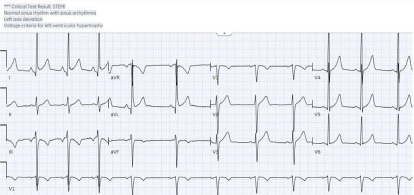 25 year old with chest pain. What do you think? 
#ECG #EKG #FOAMed #MedEd #CardioTwitter #medicalstudent #paramedic #EmergencyMedicine