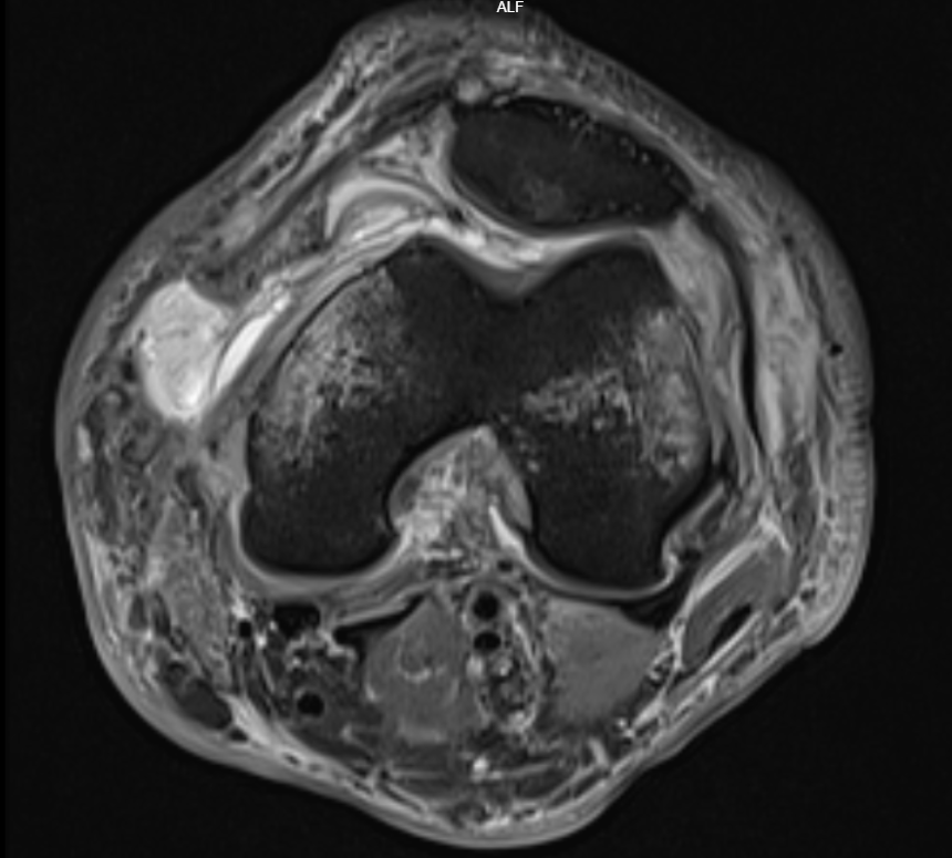 Medial Gastrocnemius origin avulsion fracture. MCL and MPFL Avulsion fracture Medial capsular defect