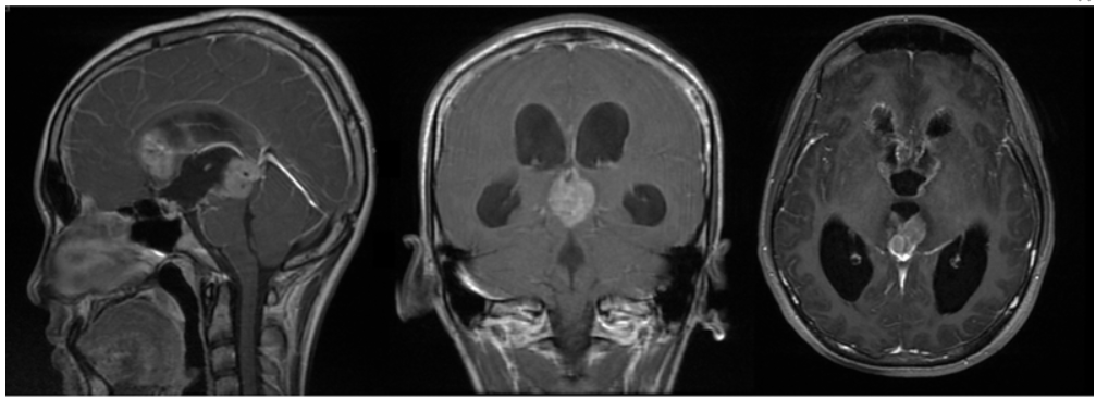 Contrast-enhanced T1 images of a pineal germinoma, with features of central calcifications, cyst formation, and hemorrhage, from "Intracranial Germ Cell Tumors" by Dr. Teri Danielle You Ying Yeoh. Subscribe to Seminars in Neurology at bit.ly/3KsxVgn  #neurotwitter