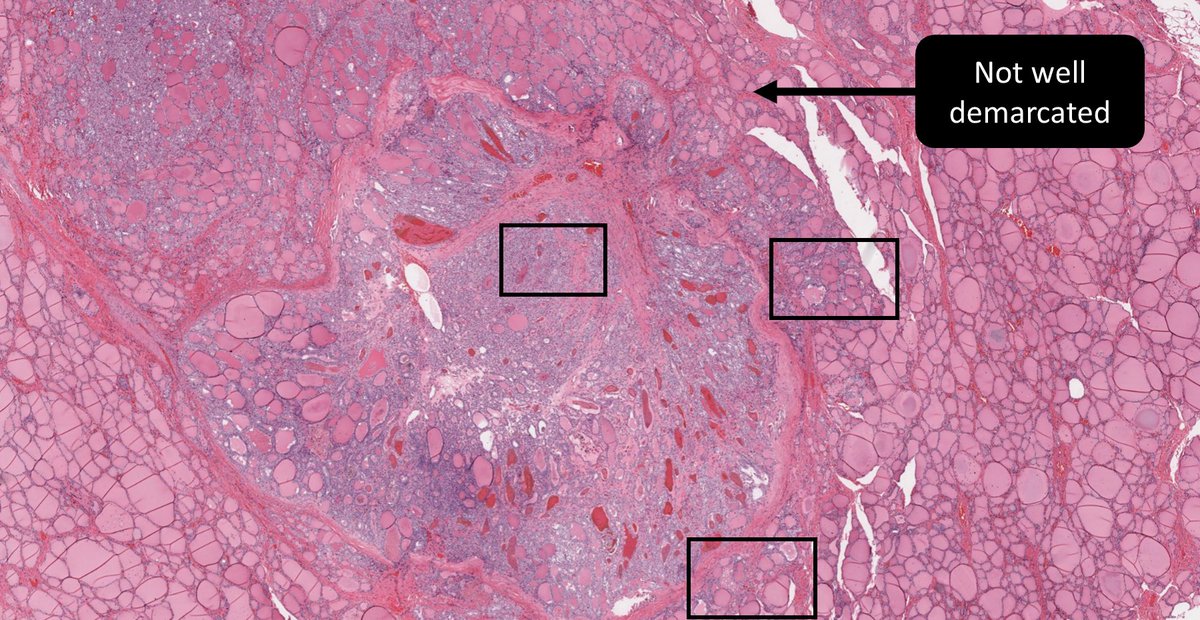 DrCycloPath's tweet image. ____ Follicular Variant Papillary Thyroid Carcinoma
A) Non-invasive encapsulated
B) Invasive encapsulated
C) Invasive
D) None of the above
🔬dpa-dapa.com/public/display…
#EndoPath #ENTPath #PathTwitter #PathResidents