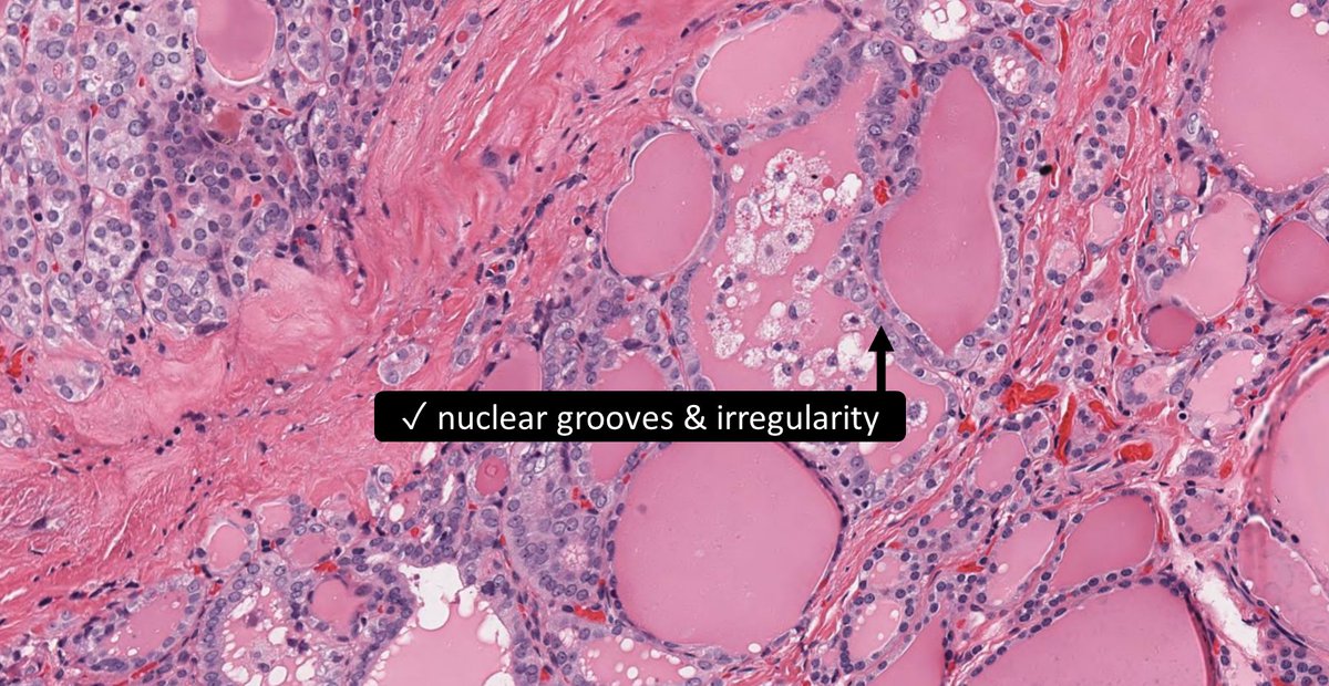 ____ Follicular Variant Papillary Thyroid Carcinoma
A) Non-invasive encapsulated
B) Invasive encapsulated
C) Invasive
D) None of the above
🔬dpa-dapa.com/public/display…
#EndoPath #ENTPath #PathTwitter #PathResidents