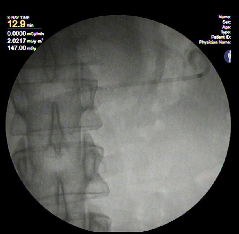 DPDS detected on ERP. EUS-guided pancreatico-gastrostomy done successfully
#GITwitter