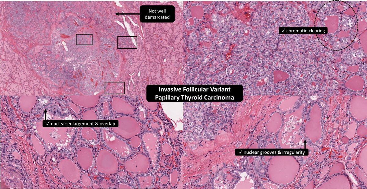 sufficient PTC nuclear features (≠D)
no capsule → don’t get fancy with NIFTP (≠A) or EFVPTC (≠B)
#EndoPath #ENTPath #PathTwitter #PathResidents
✅“Invasive FVPTC” 🙂
