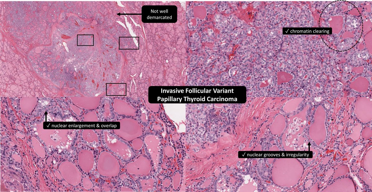 sufficient PTC nuclear features (≠D) no capsule → don’t get fancy with NIFTP (≠A) or EFVPTC (≠B) #EndoPath #ENTPath #PathTwitter #PathResidents ✅“Invasive FVPTC” 🙂