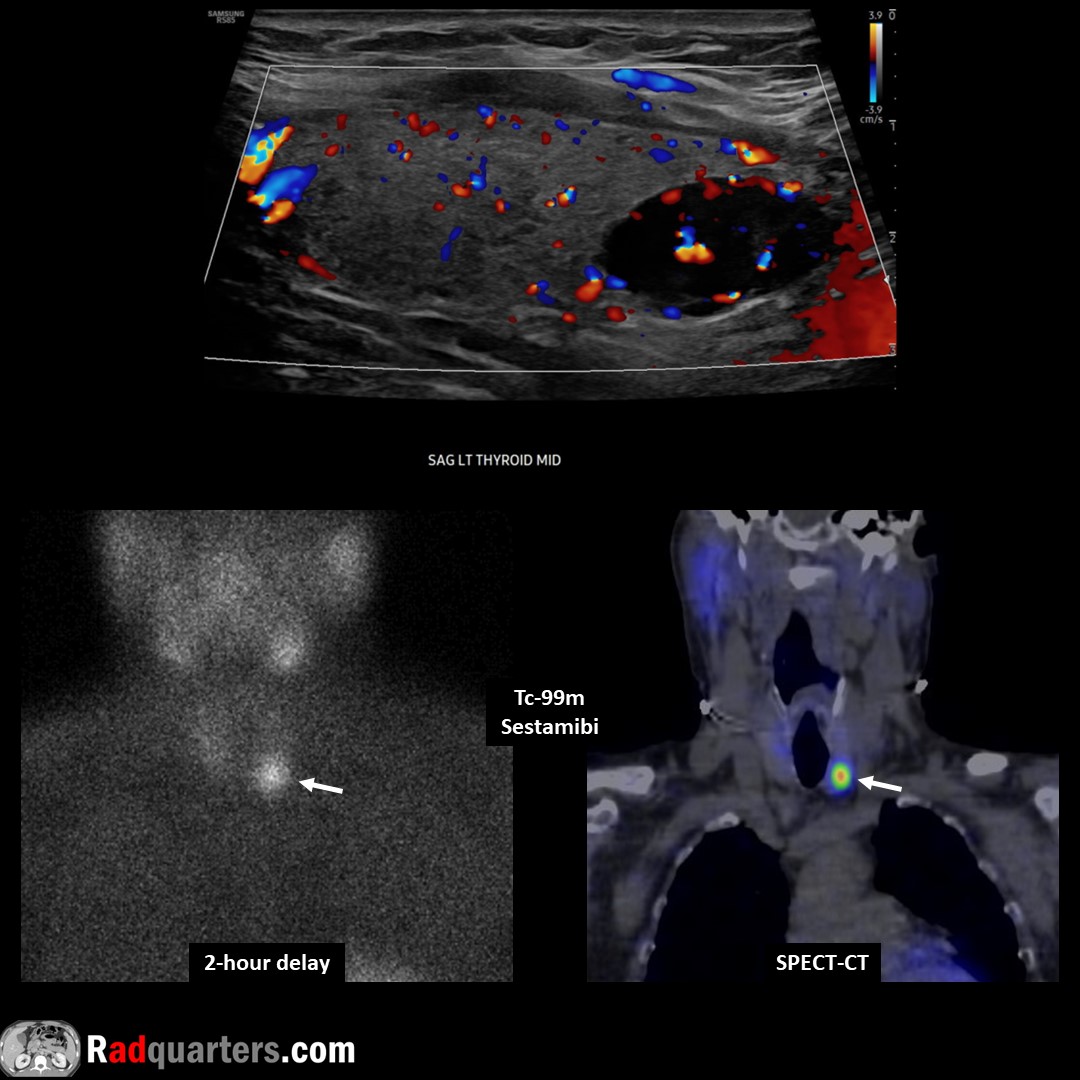 Parathyroid adenoma. Tc-99m sestamibi: Radiotracer initially taken up by both thyroid & parathyroid tissue but washes out more rapidly from thyroid & persists in adenoma on delayed images. Watch📽️ to learn more: bit.ly/pt-adenoma @BostonImaging @SamsungHealth #FOAMrad