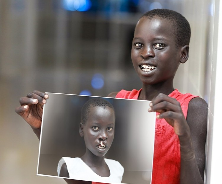 Meet Gout from South Sudan! Born with a cleft, he faced isolation and cruelty. Thanks to Smile Train's local partner in Wau, he received life-changing surgeries. Now, Gout is thriving!