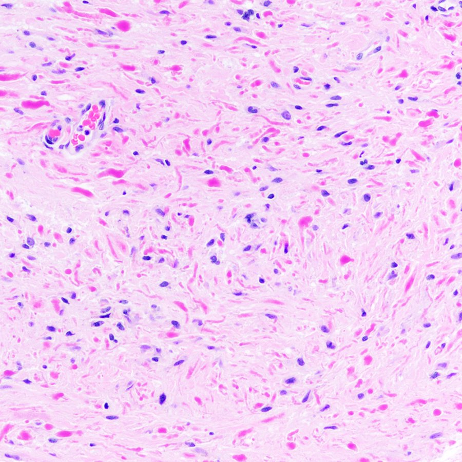 You don't need ROSE-colored glasses to diagnose this cerebellar tumor in a child. What is it? #pathology #neuropath #pathtwitter