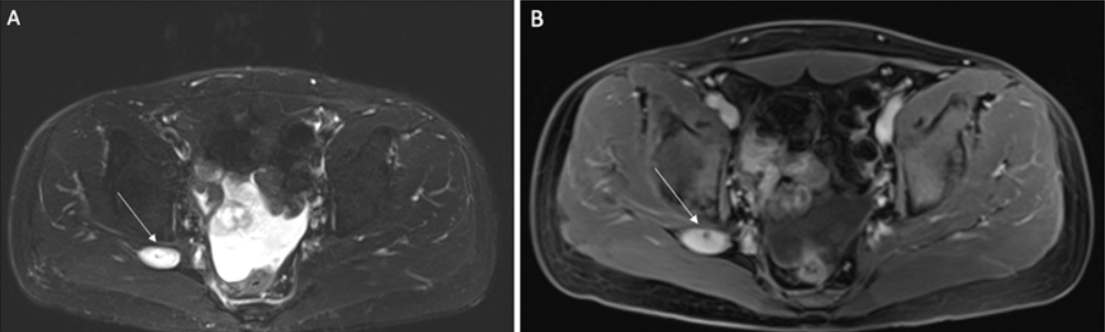 Plexiform neurofibroma in an adult NF1 patient (A) T2 hyperintense enhancing mass and (B) T1 postcontrast, from "Cancer Predisposition Syndromes in Neuro-oncology" by Dr. Brian Na. Subscribe to Seminars in Neurology at bit.ly/3KsxVgn #neurology #neurotwitter