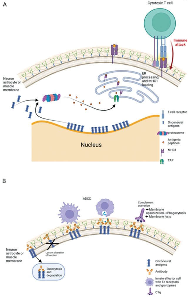 Pathogenesis of paraneoplastic neurologic disorders, from "Updates in the Management of Paraneoplastic Syndrome" by Dr. Neha Verma. Subscribe to Seminars in Neurology at bit.ly/3KsxVgn #neurology #neurotwitter