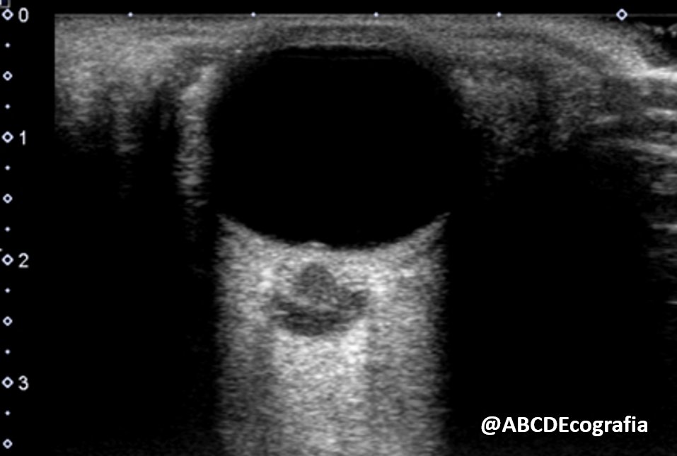 What evidence of increased ICP exists in this figure? ¿Cuales evidencias de aumento de PIC existen en esta figura?