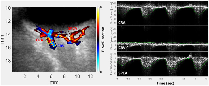 Could ultrafast plane-wave Doppler help detect blood flow velocities warranting intervention for ROP in premature babies? Interesting #NEIfunded study from @ColumbiaMed examines this question. #NeoTwitter @SciReports paper: go.nature.com/3TFO5rS