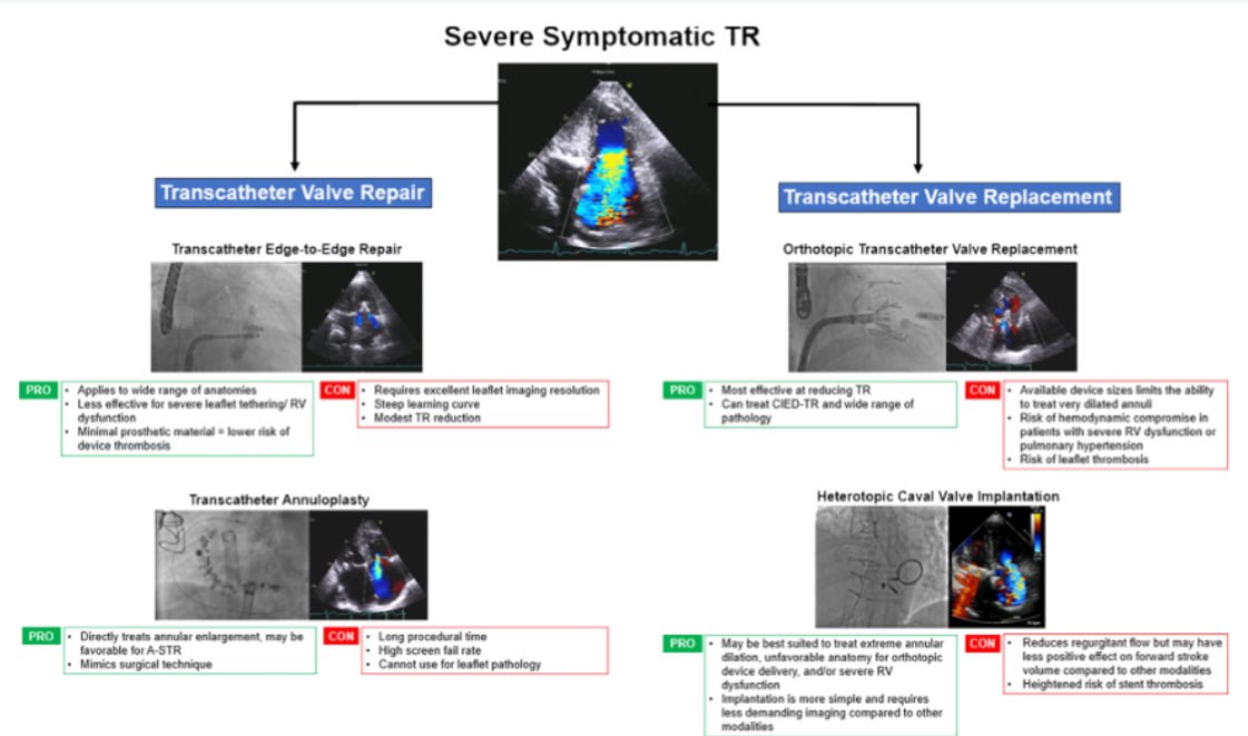 This #JACCINT issue is on fire🔥 Check out this #phenomenal #State_of_the_Art_Review discussing management of patients with #Tricuspid_regurgitation before intervention led by 🌟@GarrettWelleMD @MayoCVFellows jacc.org/doi/10.1016/j.… #CardioTwitter #ACCFIT @JACCJournals