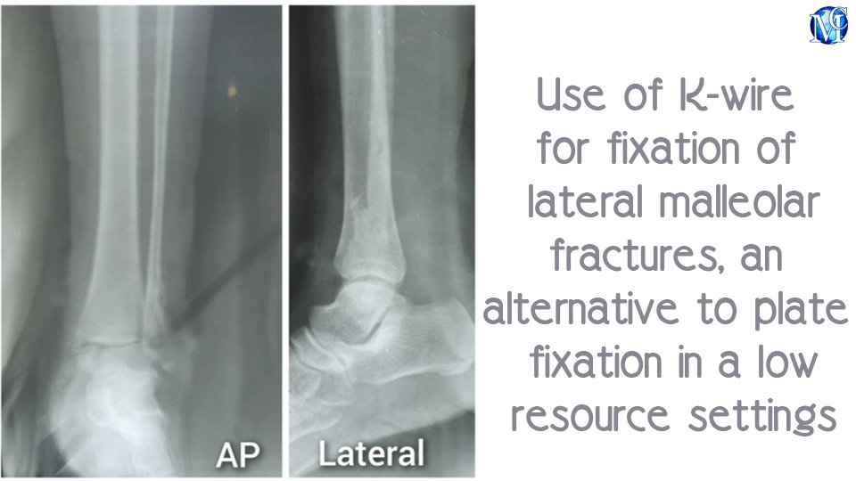 Use of K-wire for fixation of lateral malleolar #fractures, an alternative to plate fixation in a low resource settings, published in MOJ #Orthopedics & #Rheumatology by Nuradeen Altine Aliyu, et al. medcraveonline.com/MOJOR/MOJOR-16… #surgery #research #bone #joints #patient