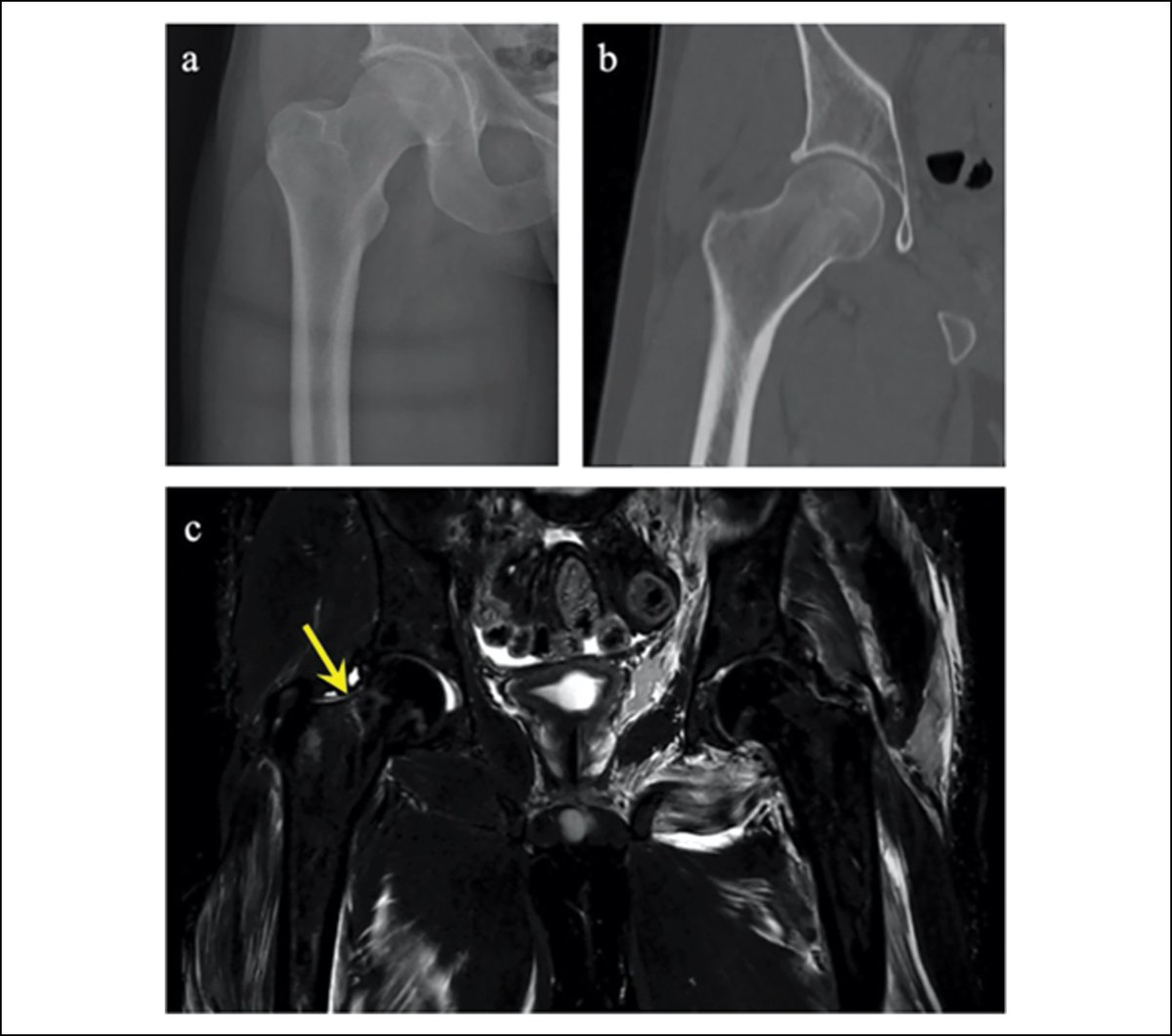 Managing high energy mechanism femoral neck fractures in young patients, read more HERE bit.ly/3TsW9MI from @UABortho